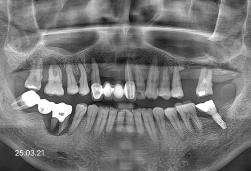 아산 온양온천역 치과 바로플란트치과 임플란트 사례