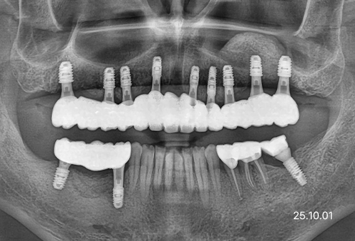 아산 온양온천역 치과 바로플란트치과 임플란트 사례
