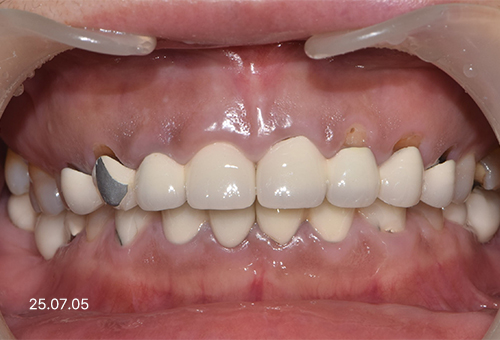 아산 온양온천역 치과 바로플란트치과 심미치료 사례