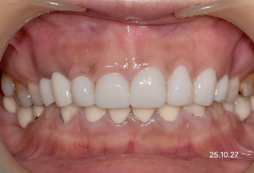 아산 온양온천역 치과 바로플란트치과 심미치료 사례