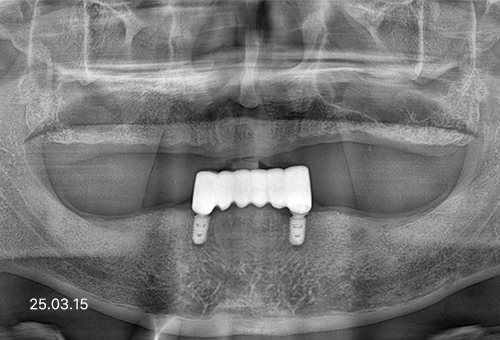 아산 온양온천역 치과 바로플란트치과 임플란트 사례