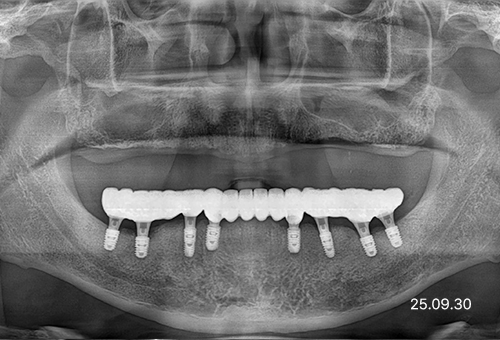 아산 온양온천역 치과 바로플란트치과 임플란트 사례