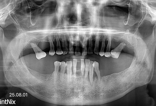 아산 온양온천역 치과 바로플란트치과 임플란트 사례