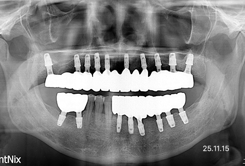 아산 온양온천역 치과 바로플란트치과 임플란트 사례