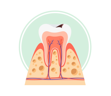 아산 온양온천역 치과 잇몸질환 단계