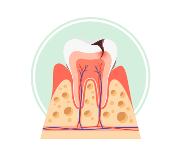 아산 온양온천역 치과 잇몸질환 단계