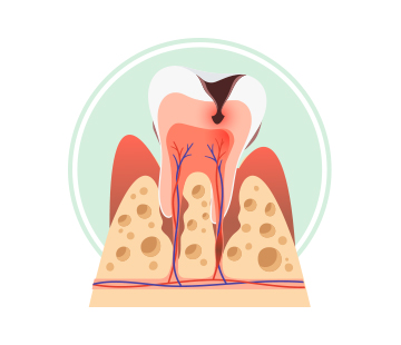 아산 온양온천역 치과 잇몸질환 단계