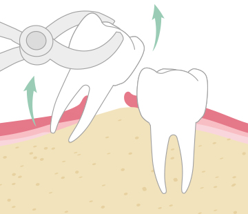 아산 온양온천역 치과 사랑니발치 단계