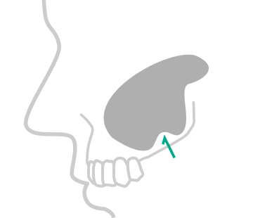 정직한 진료, 믿을 수 있는 결과 바로플란트치과 상악동거상술