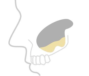 정직한 진료, 믿을 수 있는 결과 바로플란트치과 상악동거상술