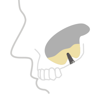 정직한 진료, 믿을 수 있는 결과 바로플란트치과 상악동거상술