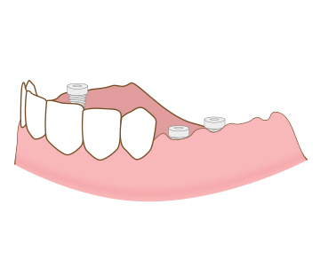 아산 온양온천역 바로플란트치과 임플란트 틀니