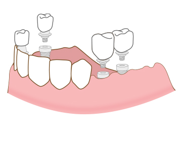 아산 온양온천역 바로플란트치과 임플란트 틀니
