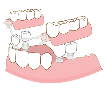 아산 온양온천역 바로플란트치과 임플란트 틀니