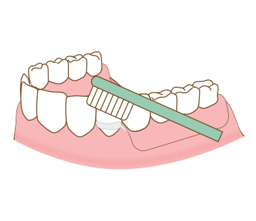 아산 온양온천역 바로플란트치과 임플란트 틀니