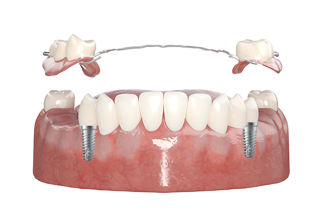 아산 온양온천역 치과 바로플란트치과 임플란트틀니