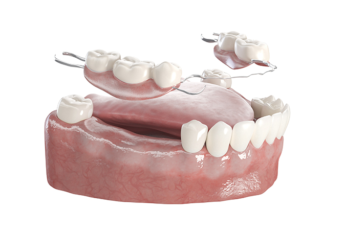 정직한 진료, 믿을 수 있는 결과 바로플란트치과 부분틀니