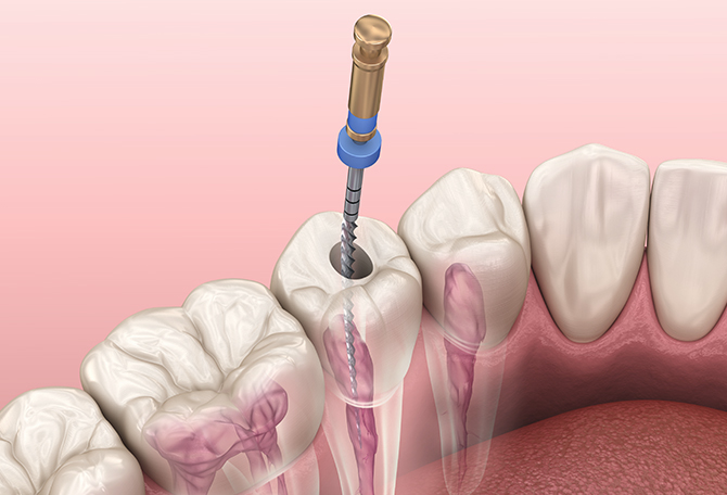 정직한 진료, 믿을 수 있는 결과 바로플란트치과 신경치료