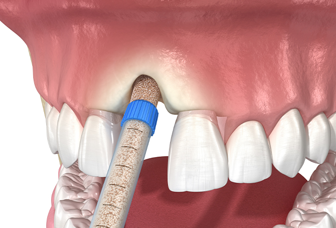아산 온양온천역 치과 바로플란트치과 상악동거상술