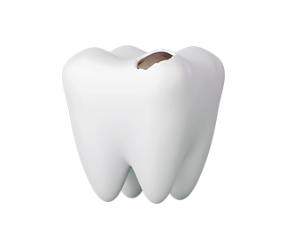 바로플란트치과 충치치료