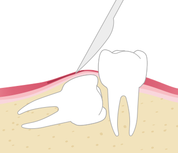 아산 온양온천역 치과 사랑니발치 단계