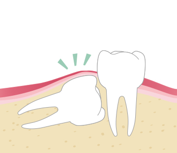 아산 온양온천역 치과 사랑니발치 단계